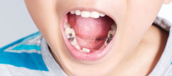 Cavity Filling For Kids Carlsbad