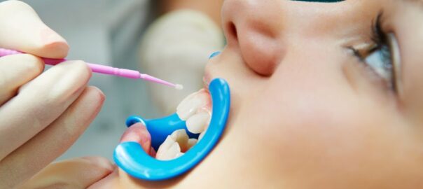 Dental Sealants Carlsbad
