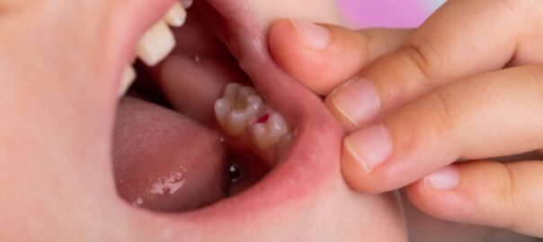Cavity Filling For Kids Carlsbad