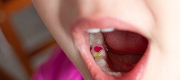 Cavity Filling For Kids Carlsbad