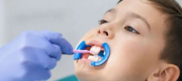 Dental Sealants Carlsbad