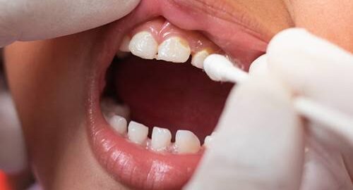 Fluoride Treatments Carlsbad