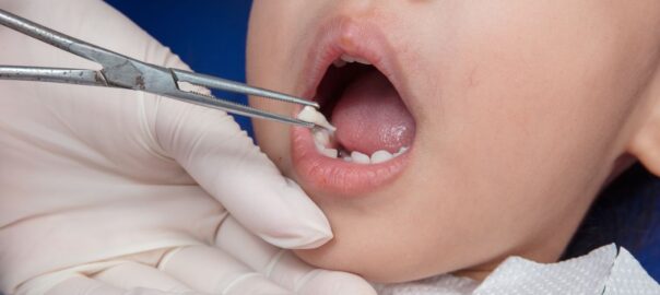 Kids Tooth Extraction Carlsbad