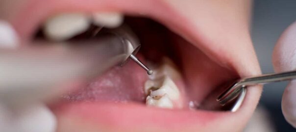 Tooth Fillings For Kids Carlsbad